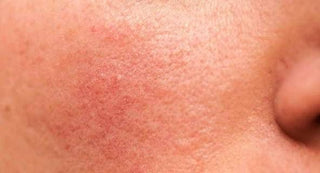 Protocollo Pelle Sensibile e con Rosacea - Routine Lenitiva Wikirose